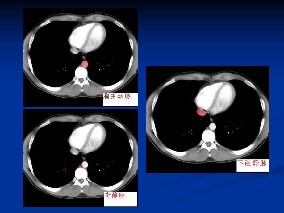 腹部CT解剖.ppt_第2页