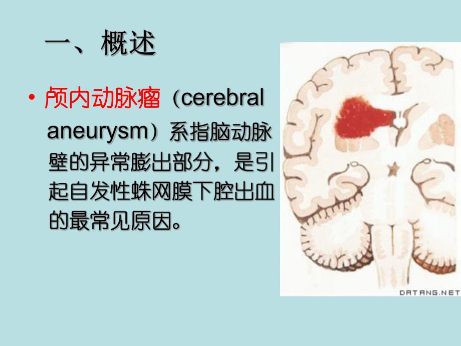 颅内动脉瘤.ppt_第2页