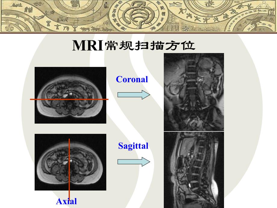 脊柱常见疾病的MRI诊断.ppt_第2页