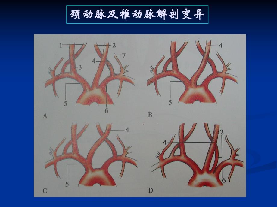 颈动脉疾病超声诊断.ppt_第3页