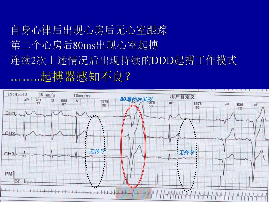 起搏器的特殊功能及心电图表现.ppt_第3页