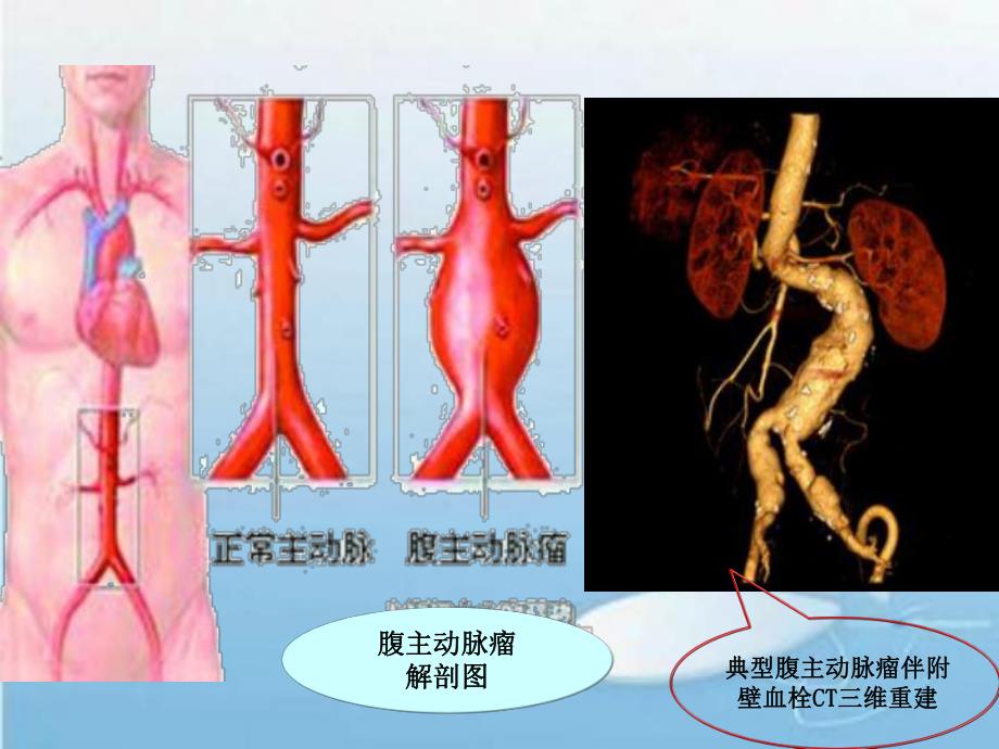 腹主动脉瘤.ppt_第3页