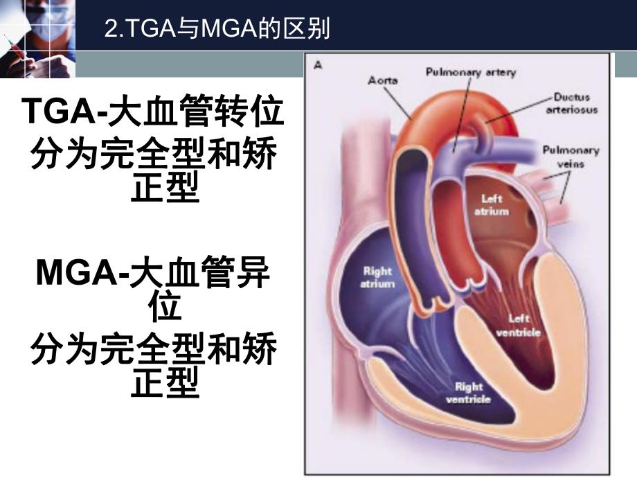 超声心动图中节段法对于大血管转位的诊断应用.ppt_第3页