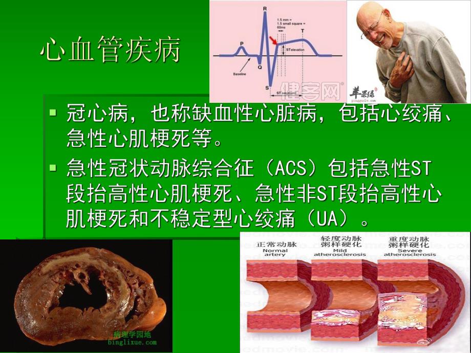 心脑血管疾病的预防.ppt_第3页