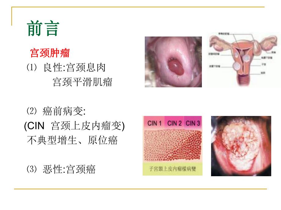 宫颈肿瘤.ppt_第2页