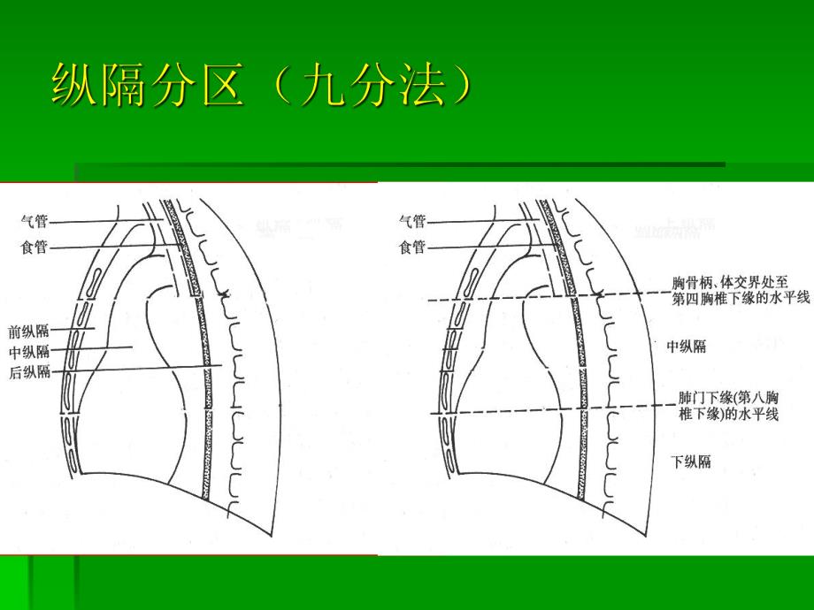 纵隔疾病.ppt_第3页