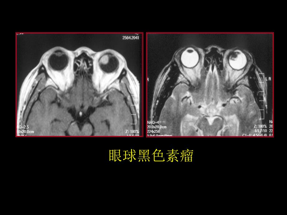 眼球肿瘤的影像学诊断..ppt_第3页