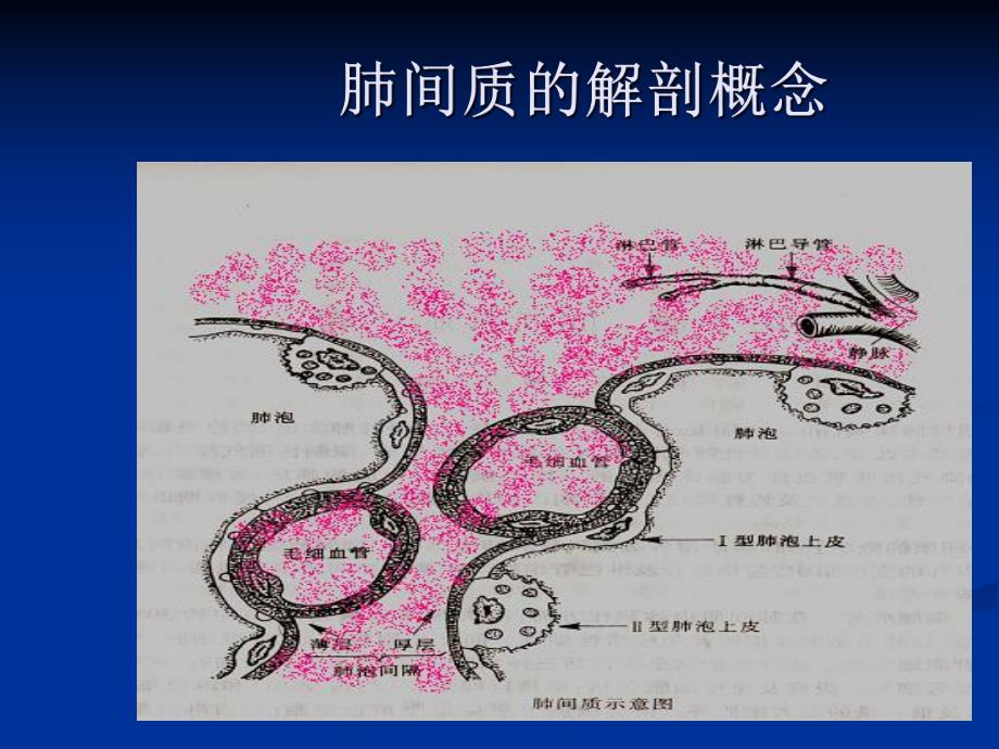 4特发性肺纤维化.ppt_第3页