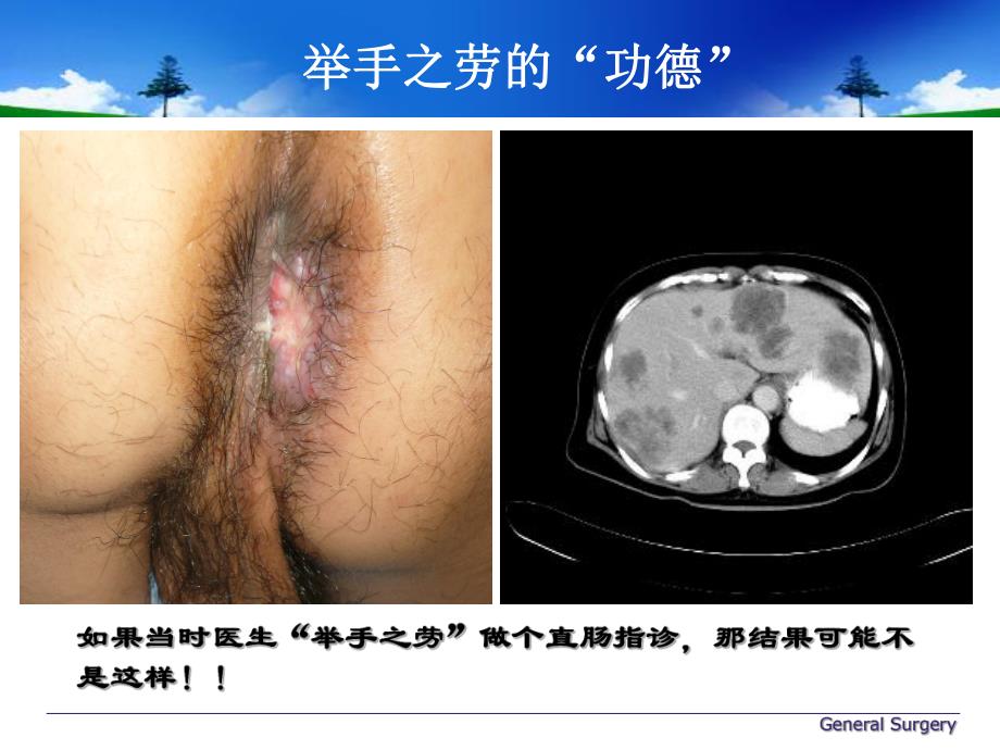 医院直肠癌.ppt_第3页