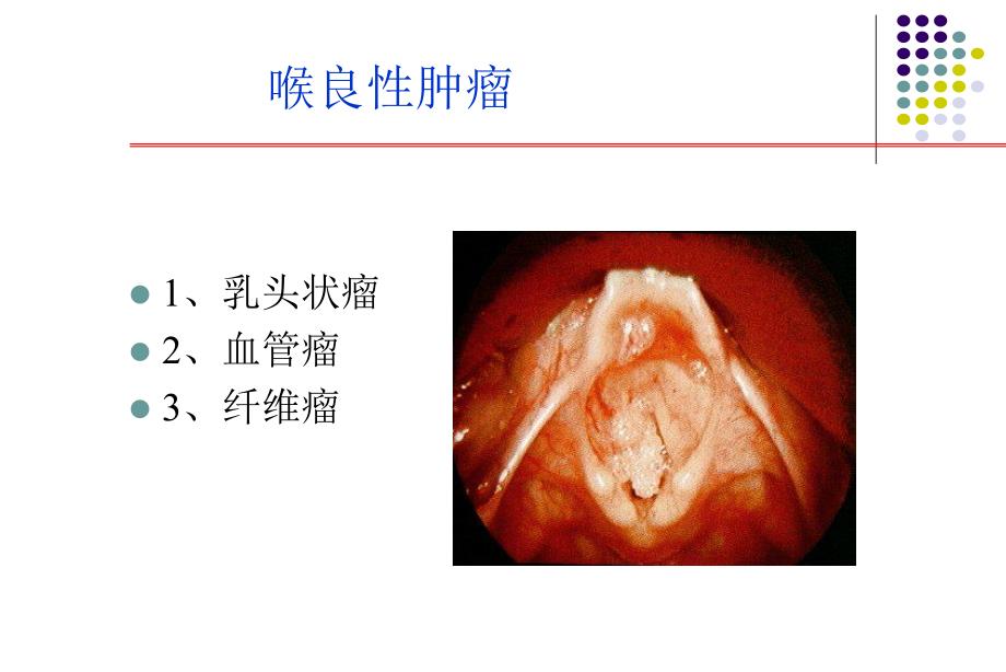 【精品】喉部肿瘤39.ppt_第2页