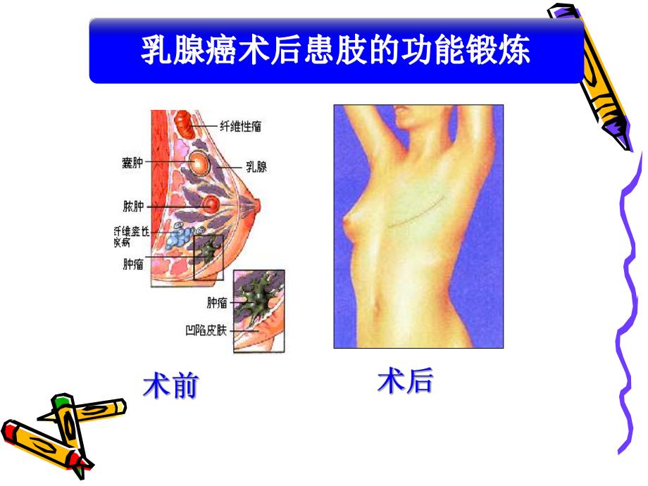 乳腺癌术后的功能锻炼.ppt.ppt_第1页