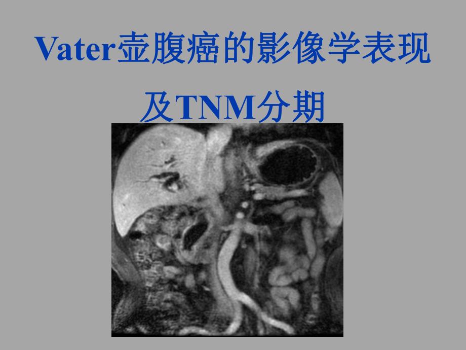 Vater壶腹癌的影像学表现及TNM分期.ppt_第1页