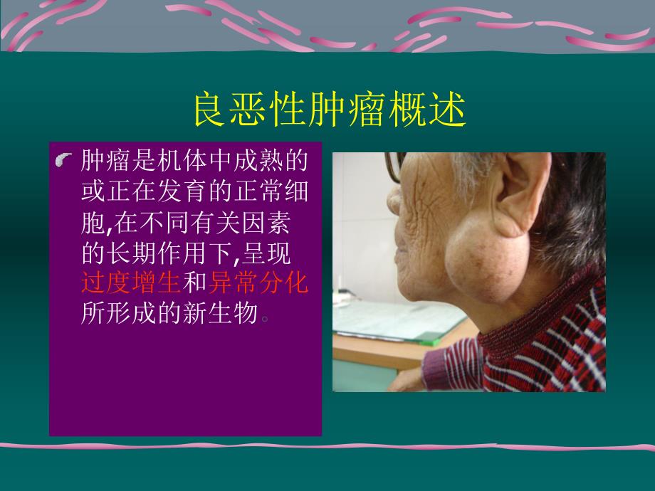 喉癌喉良性肿瘤.ppt.ppt_第3页