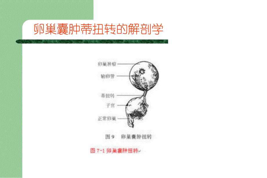 [医药]卵巢囊肿蒂扭转的诊断与治疗PPT.ppt_第2页