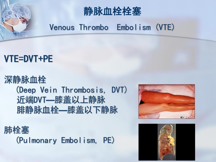 ICU深静脉血栓的预防.ppt_第2页