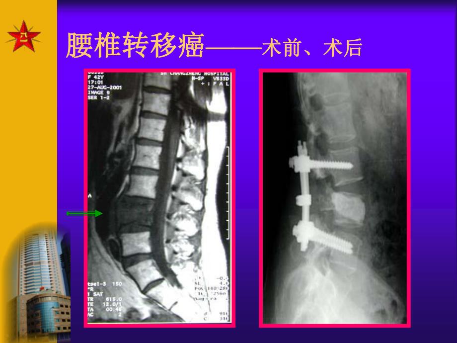 骨肿瘤.ppt.ppt_第3页