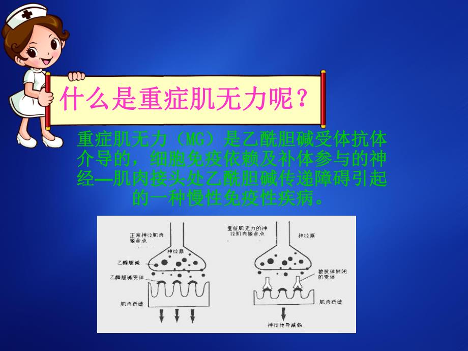 重症肌无力患者的护理.ppt_第2页