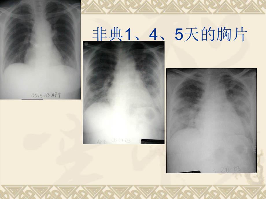 呼吸机的急诊应用.ppt_第2页