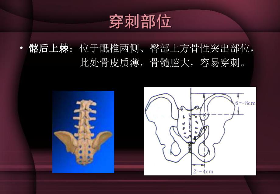 骨髓穿刺术ppt医学幻灯片.ppt_第3页