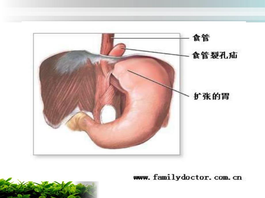 食道裂孔疝护理.ppt_第3页