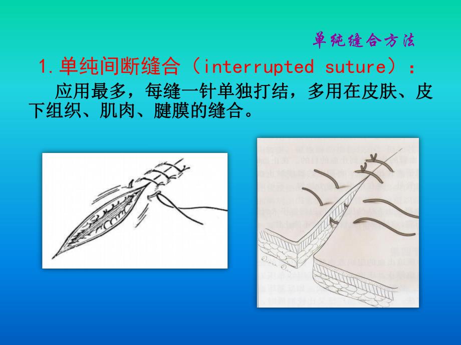 离体肠管吻合.ppt_第3页