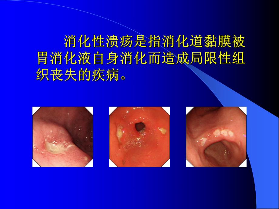 小儿消化性溃疡及进展1.ppt.ppt_第2页