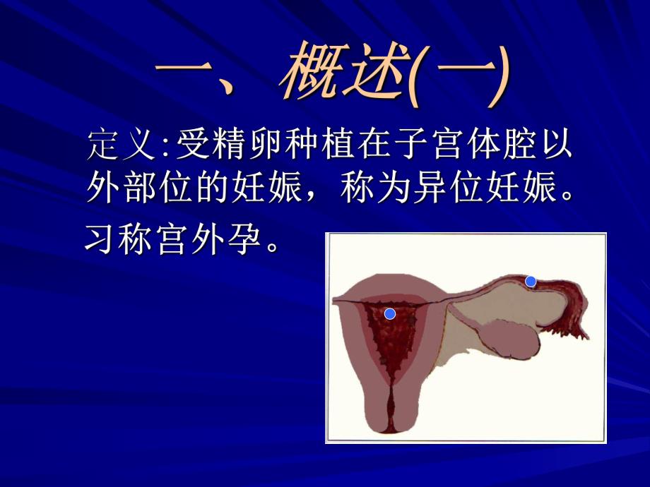 异位妊娠及护理..ppt_第3页