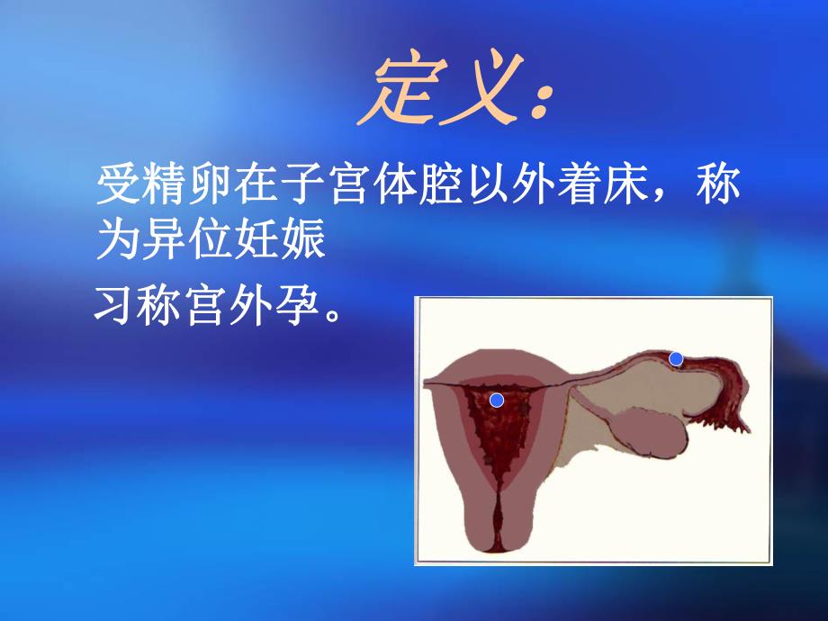 异位妊娠(课件).ppt_第2页