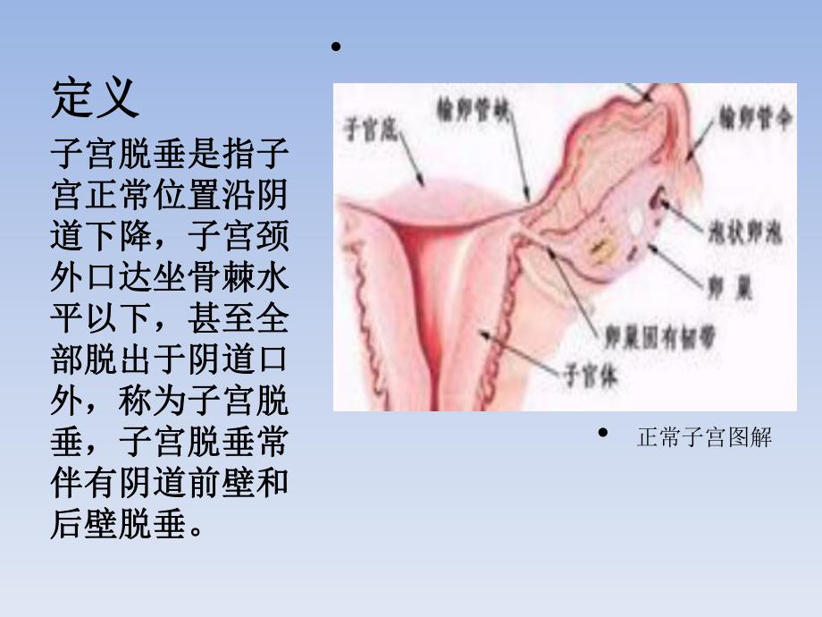 子宫脱垂.ppt.ppt_第2页