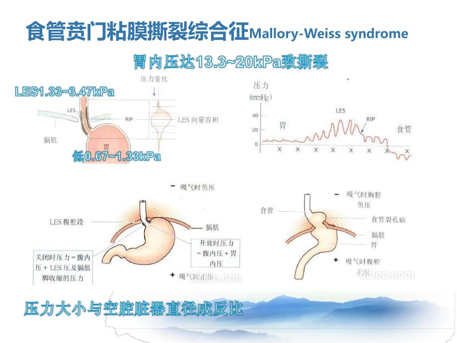 上消化道出血少见病因.ppt_第3页