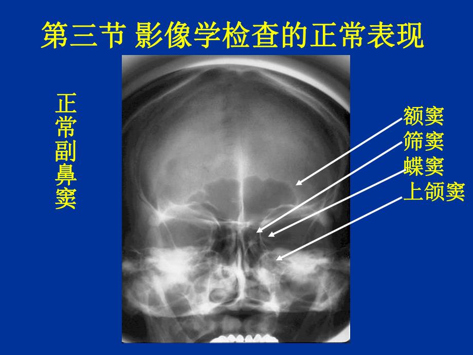 鼻窦疾病实习片.ppt_第2页