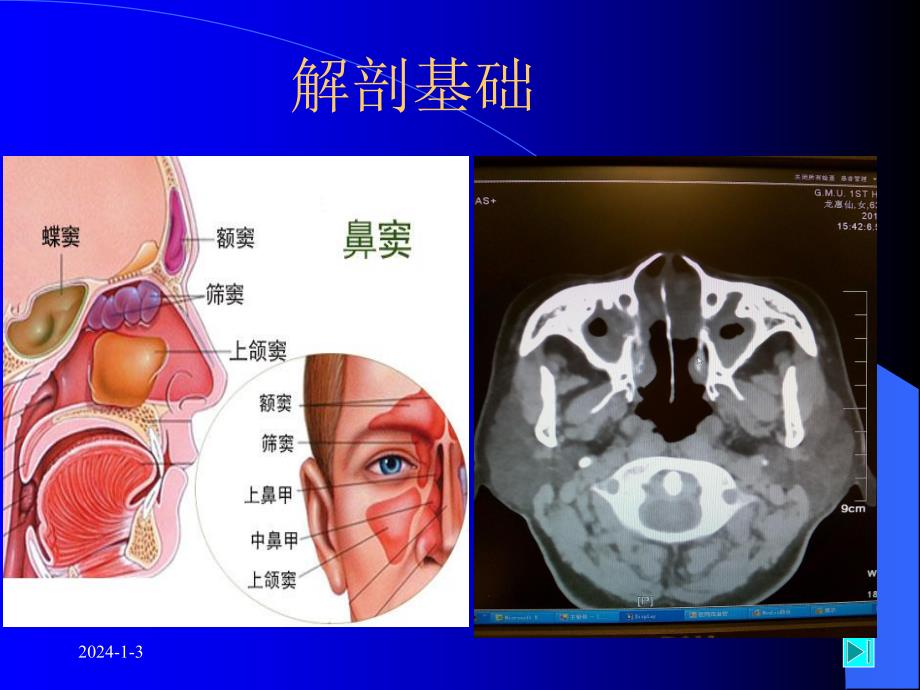 鼻息肉幻灯片.ppt_第3页