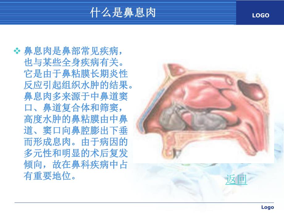 鼻息肉.ppt.ppt_第3页