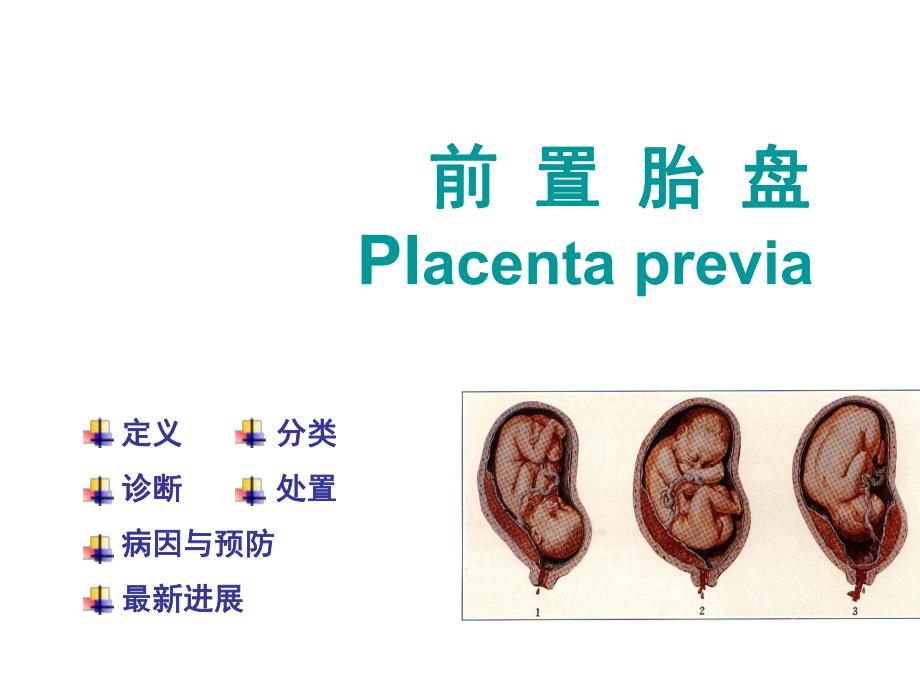 医院妇产科培训资料前置胎盘认识与学习培训PPT.ppt_第3页