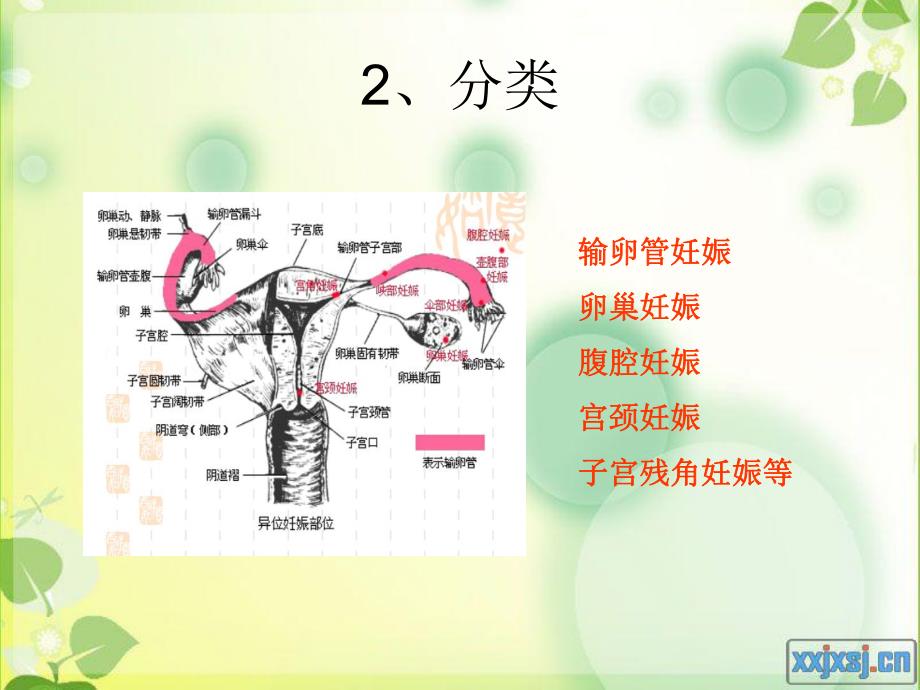 宫外孕的治疗与护.ppt_第3页