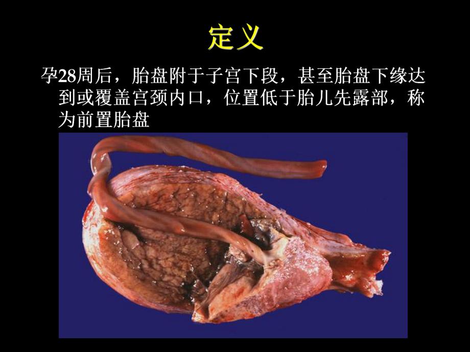 前置胎盘.ppt_第2页