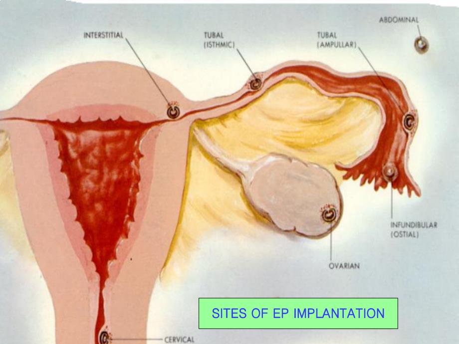 异位妊娠1.ppt_第3页
