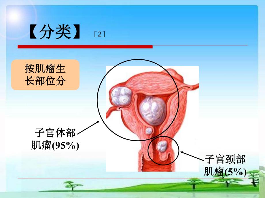 子宫肌瘤围手术期护理.ppt.ppt_第3页