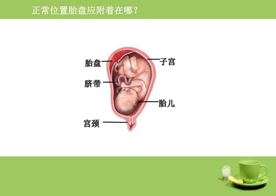 前置胎盘PPT.ppt_第2页