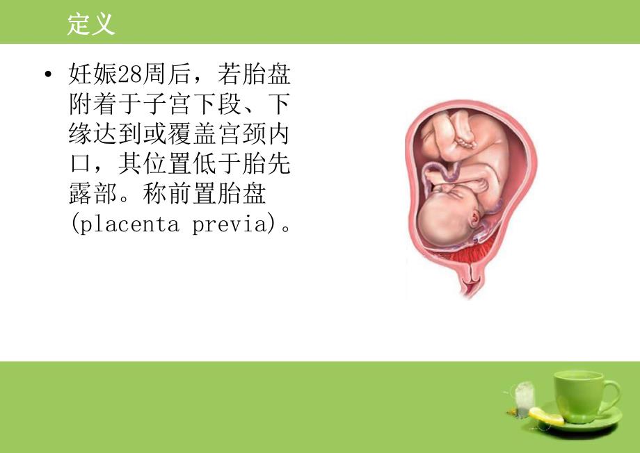 前置胎盘PPT.ppt_第3页