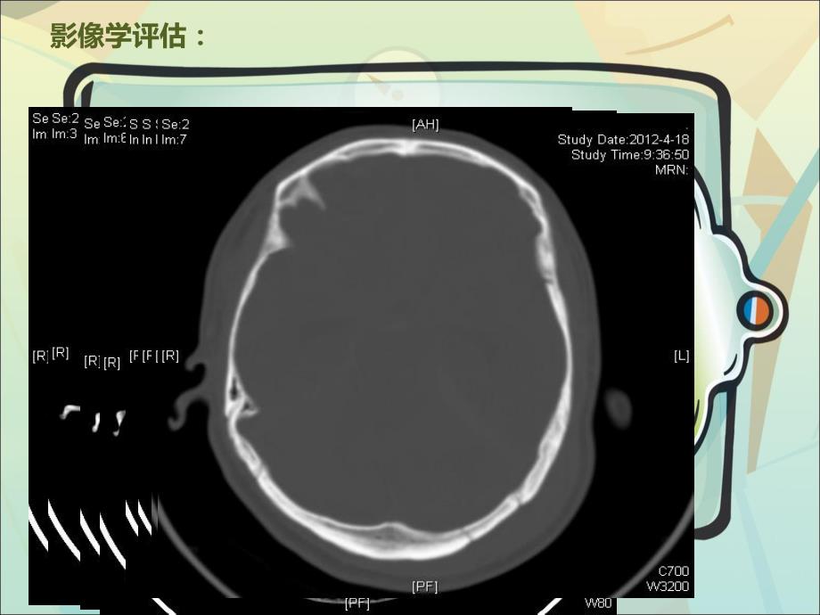 颅内压监测病例分享.ppt.ppt_第3页