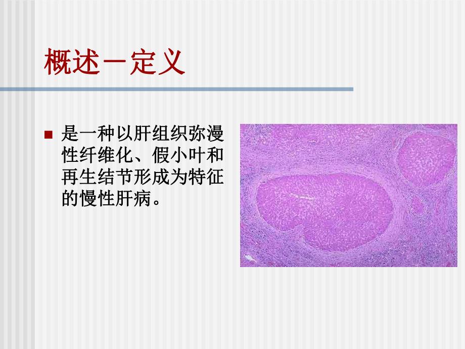 肝硬化消化内科.ppt_第3页