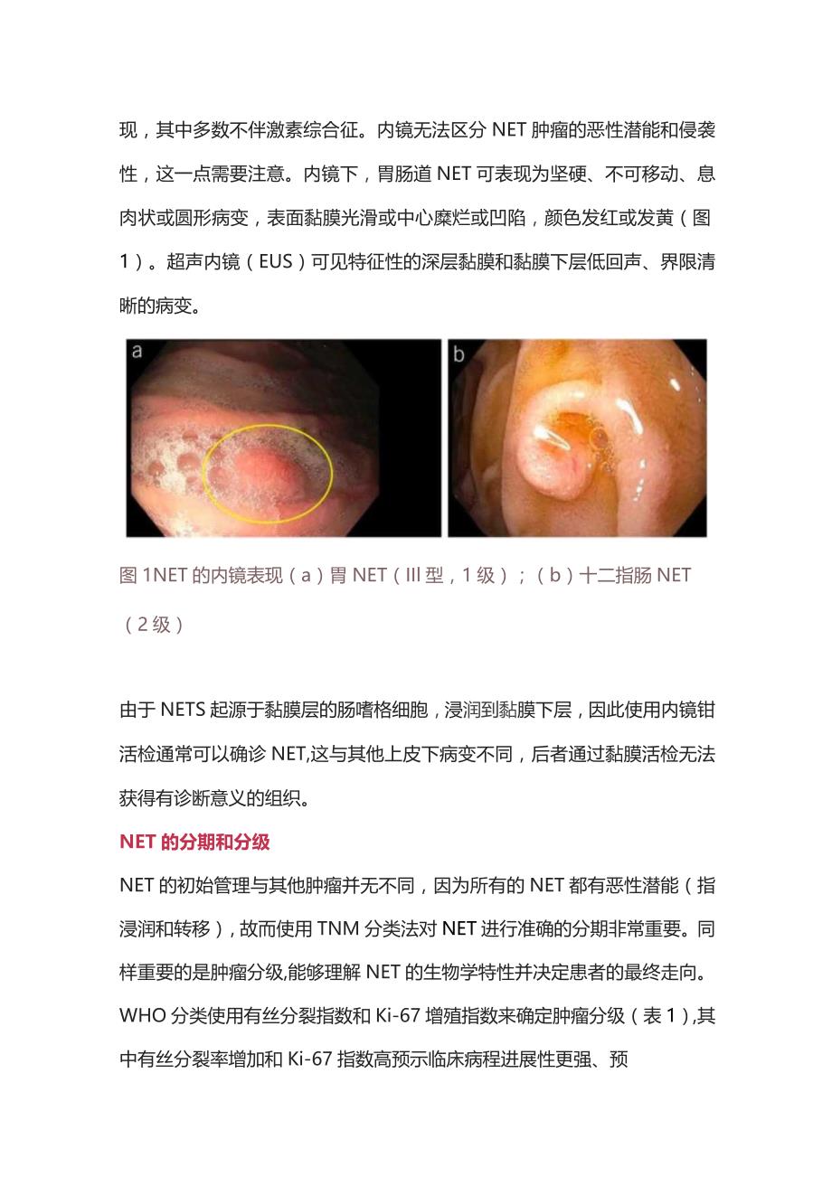 2023胃肠道神经内分泌瘤.docx_第2页