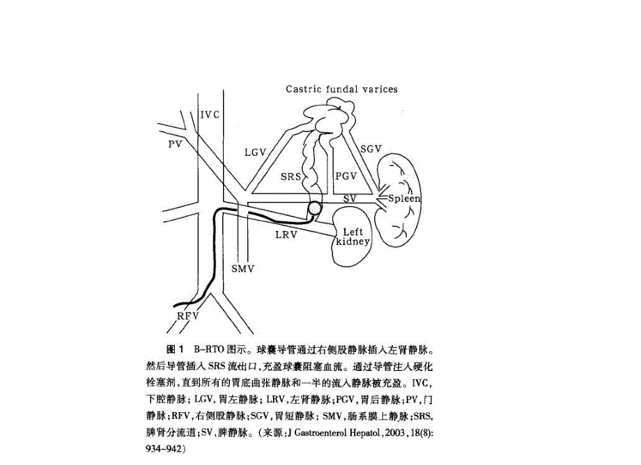 肝硬化门脉高压症的BRTO治疗.ppt.ppt_第3页