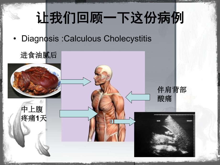 结石性胆囊炎的诊断和治疗.ppt_第2页