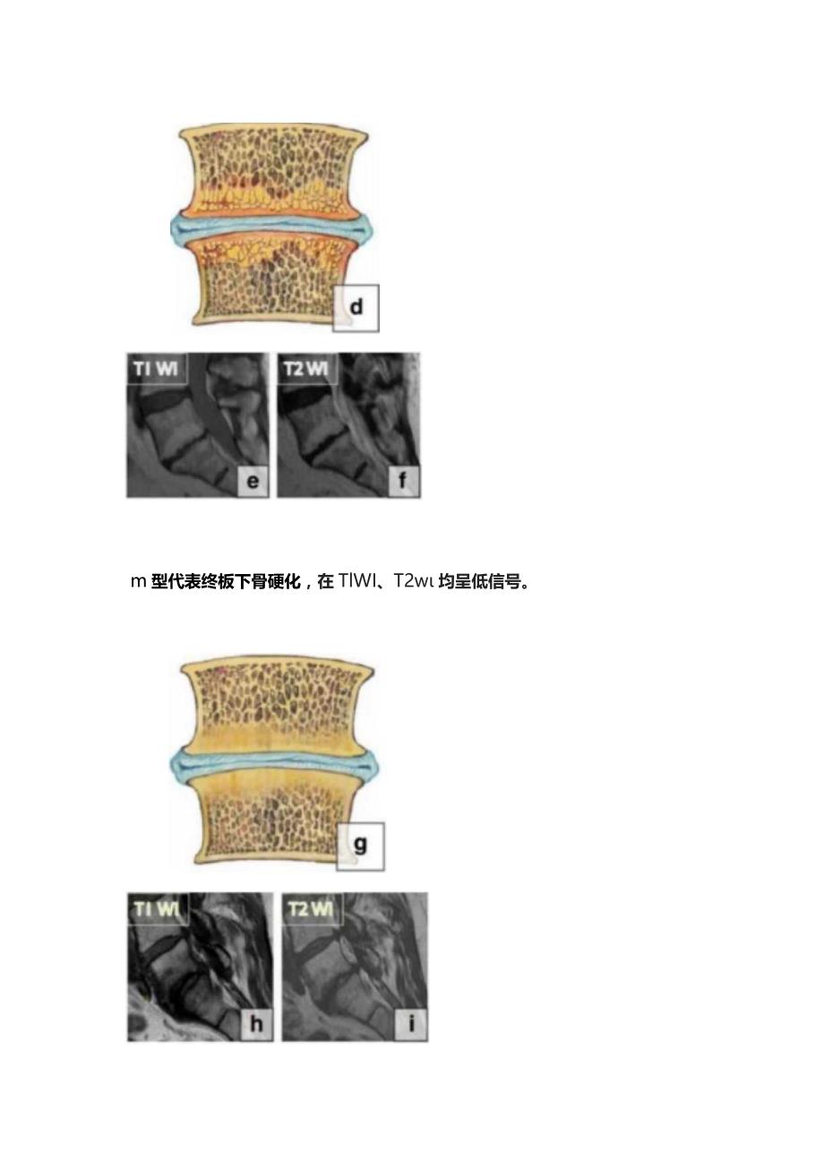 2023椎体终板炎的分型分级、诊断、治疗策略.docx_第3页