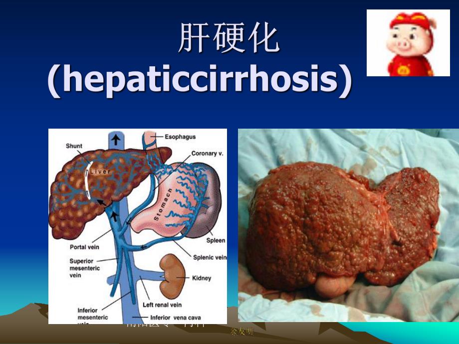 肝硬化完整.ppt_第1页