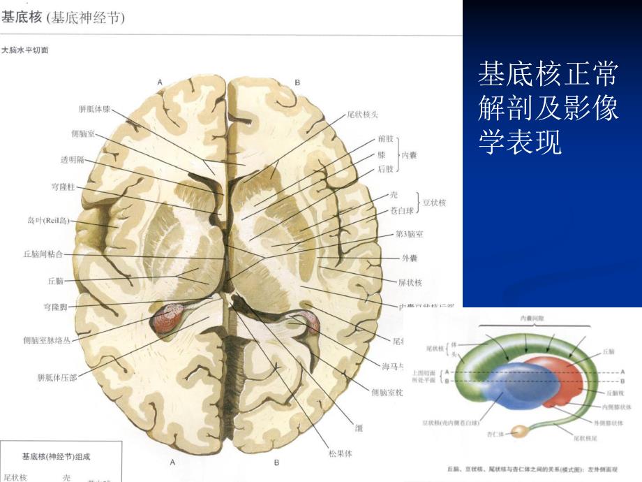 大脑深部对称性灰质核团病变的病因与MRI诊断 放射科.ppt_第3页