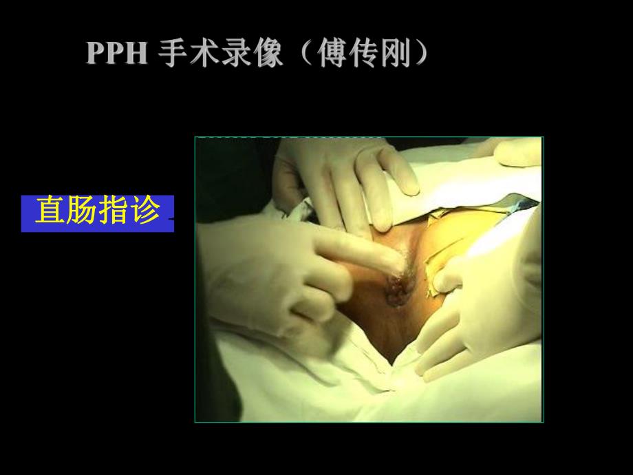 PPH手术治疗环形脱垂性内痔.ppt_第3页