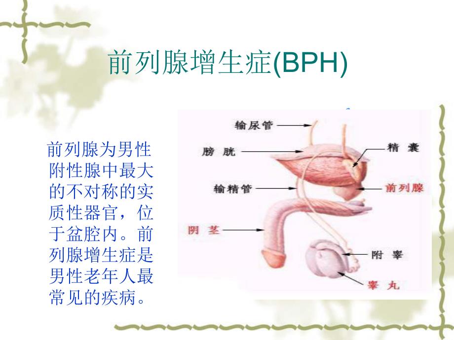 前列腺增生症.ppt_第2页